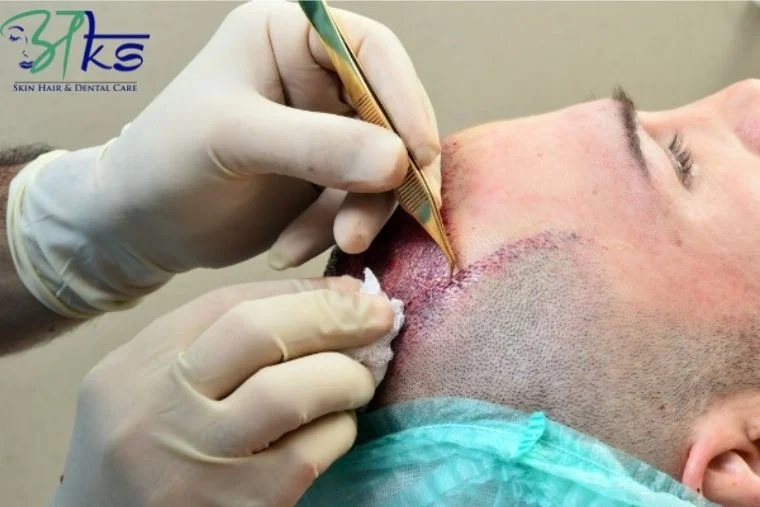 Advance Hair Transplant Treatment in Gurgaon