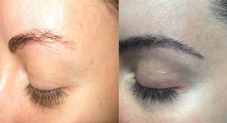 Are Eyebrow Transplants Permanent