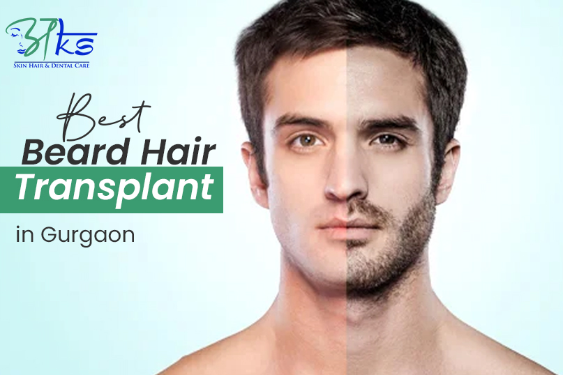 Best Beard Hair Transplant in Gurgaon