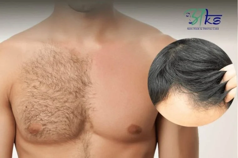 Best Body Hair Transplant in Gurgaon Delhi NCR