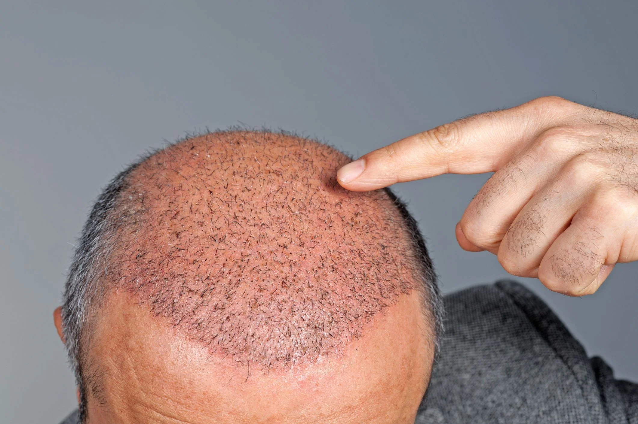 Do hair plugs grow