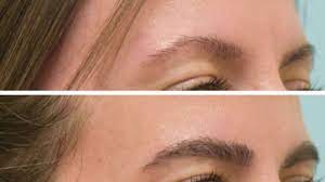 How long does Eyebrow Transplant Last