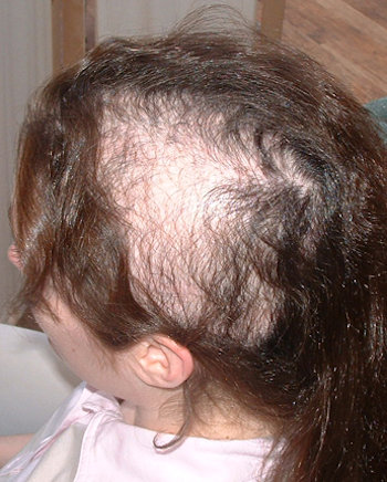 How do you make trichotillomania grow your hair faster