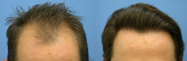 What are the disadvantages of hair transplant