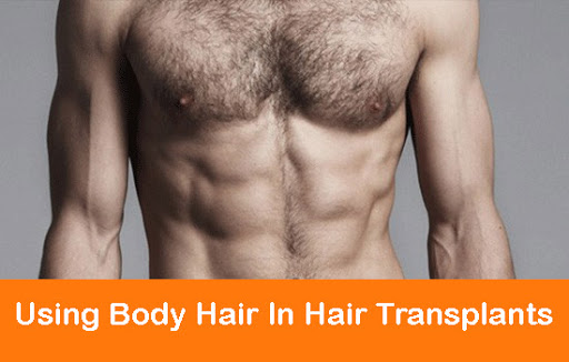 Can I use body hair for transplant
