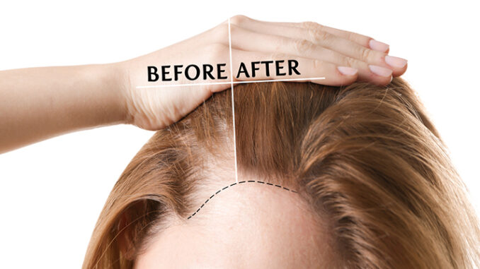 What is the best treatment to regrow hair