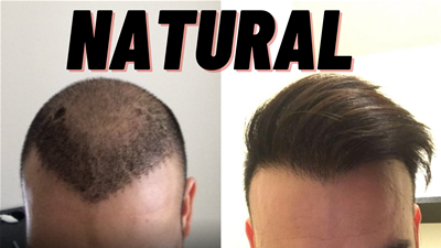 Do Hair Transplants look Natural