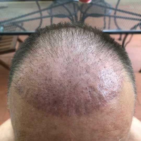 What happens after 2 months of hair transplant