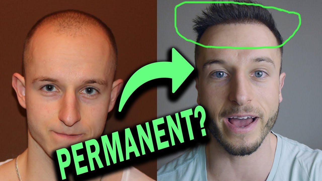 Is a Hair Transplant Permanent