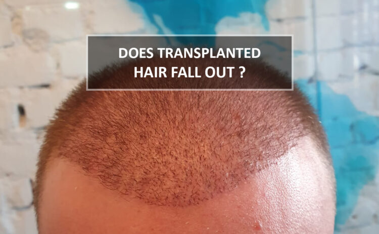 Does hair fall after transplant