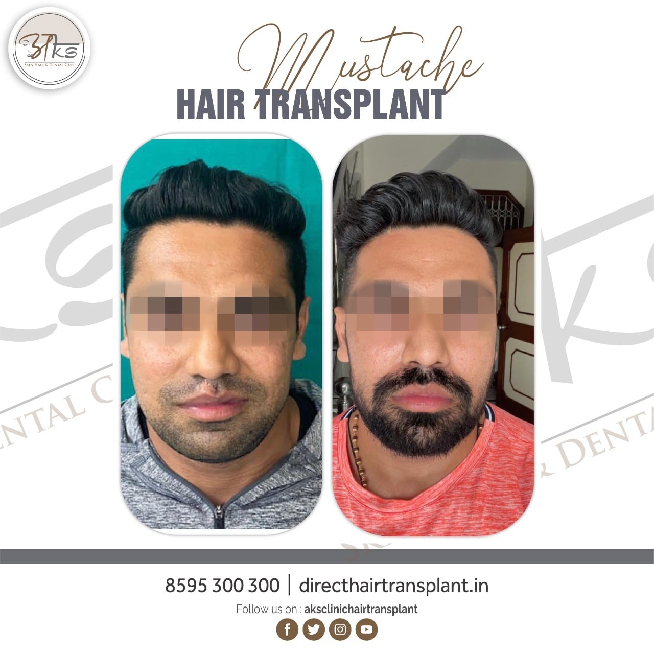 Mustache Transplant in Gurgaon