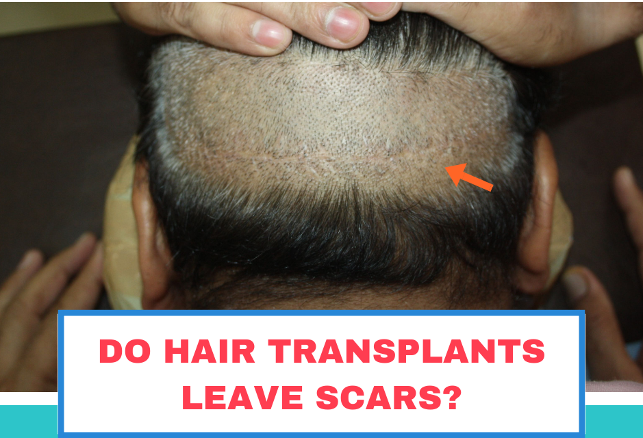 Does FUE Hair Transplant leave Scars