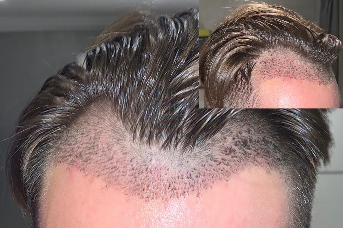 How long does transplanted hair last