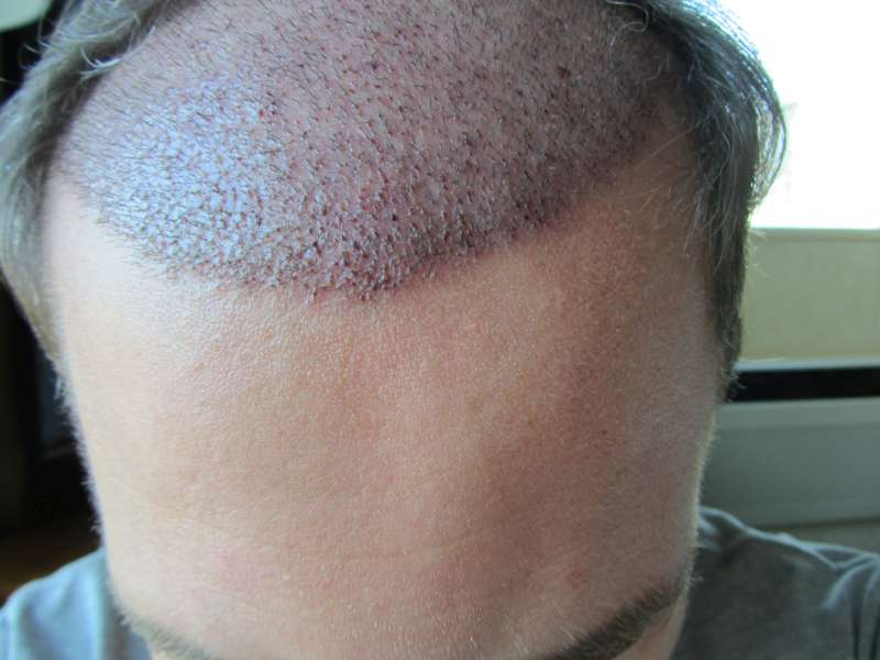 How long is recovery from hair transplant