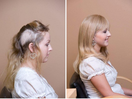 Is it possible to grow hair after trichotillomania