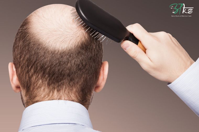Tips To Go Back To Work After A Hair Transplant |