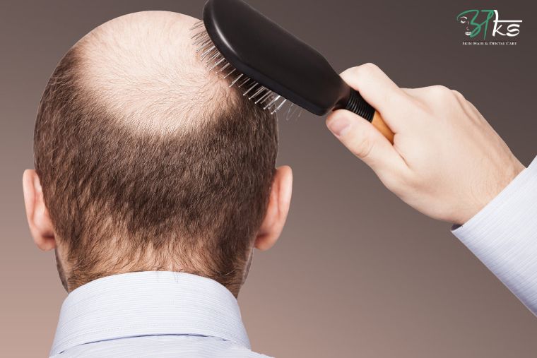 Tips To Go Back To Work After A Hair Transplant