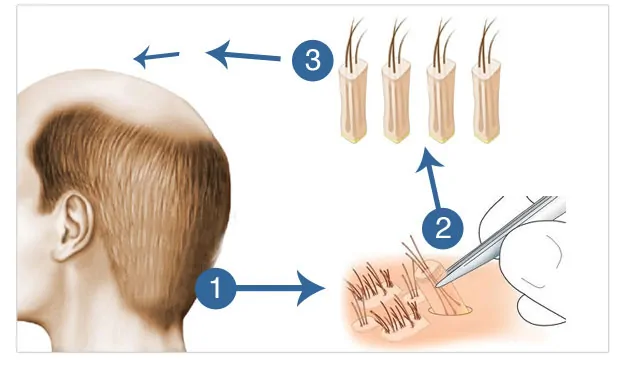 What is bio FUE hair transplant