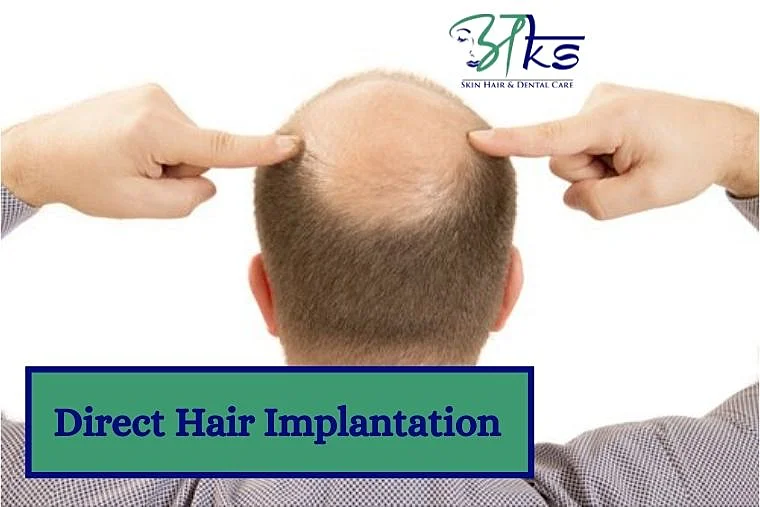 What is Direct Hair Implantation