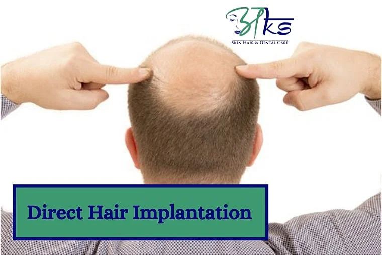What is Direct Hair Transplantation