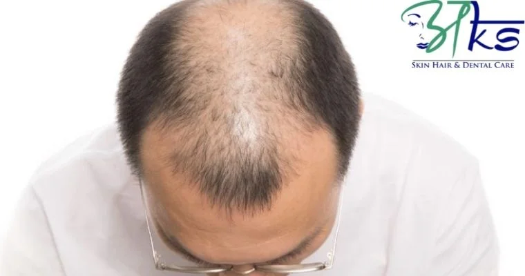 What is the alternative to Hair Transplant