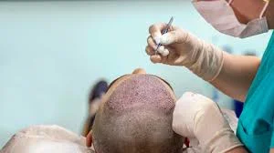 What is the most successful Hair Transplant Procedure