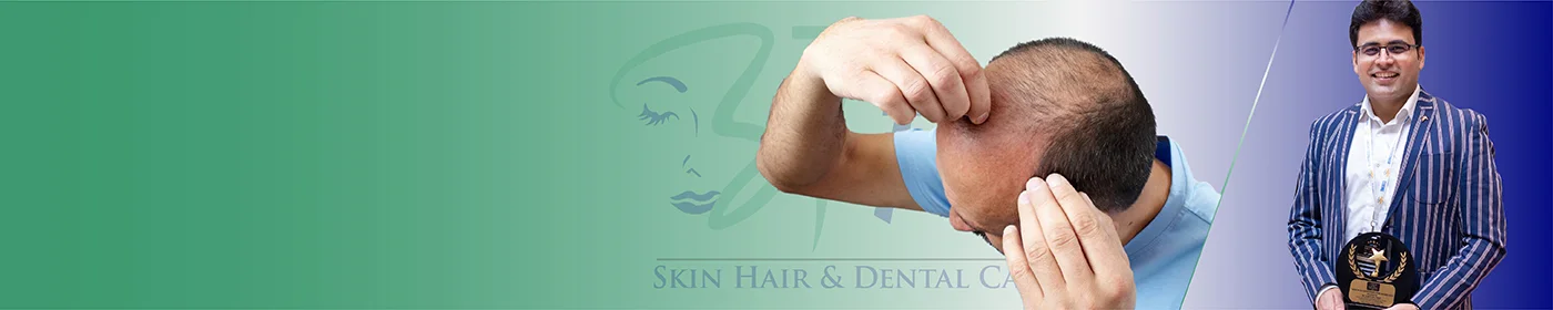 Best Hair Loss & Hair Fall Treatment in Gurgaon Delhi NCR