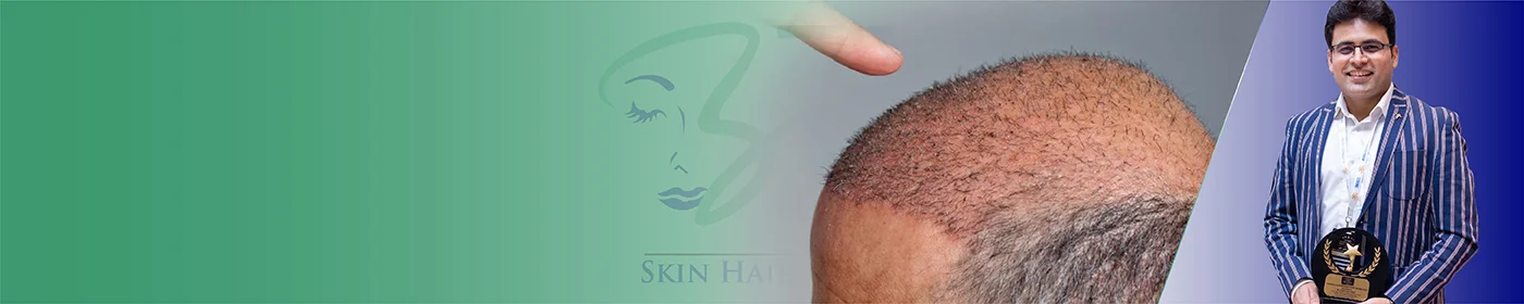 Bio stimulated FUE Hair Transplant in Gurgaon Delhi NCR